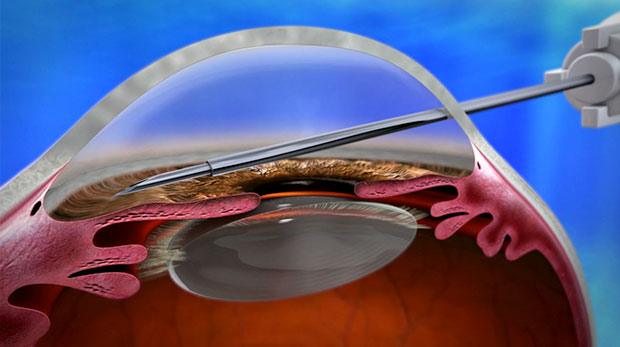 What is Minimally-Invasive Glaucoma Surgery? - Dr Colin I Clement